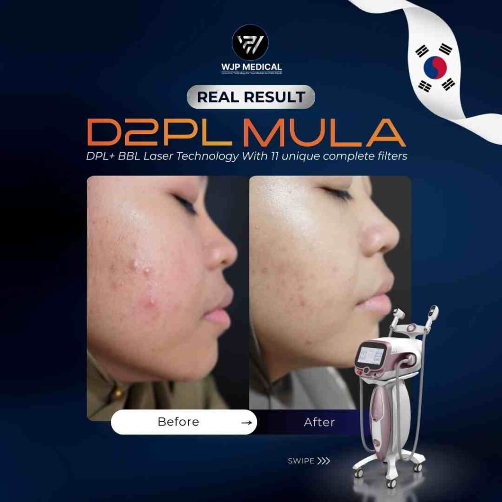 D2PL MULA BEFORE AFTER TREATMENT