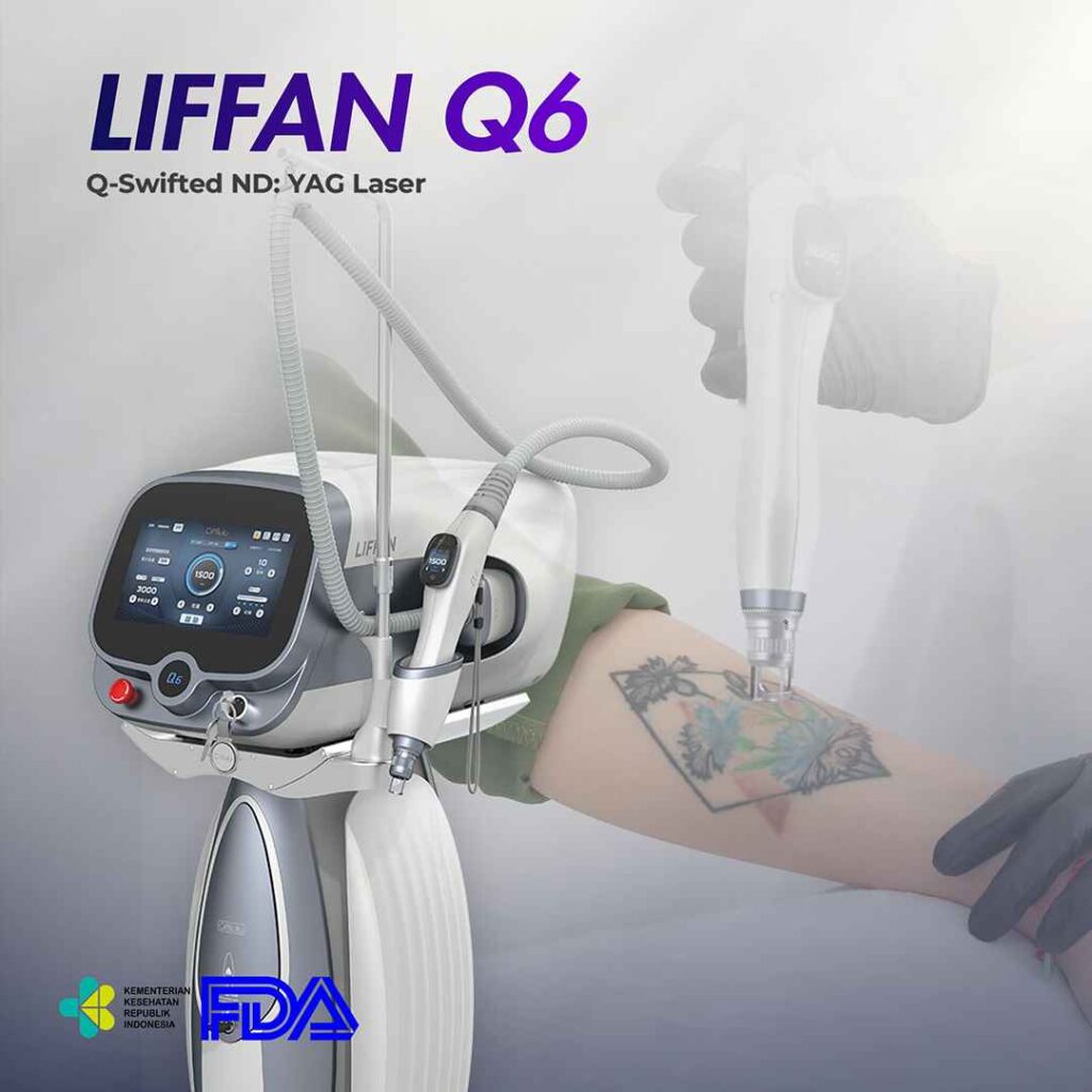 LIFFAN Q Switch ndyag