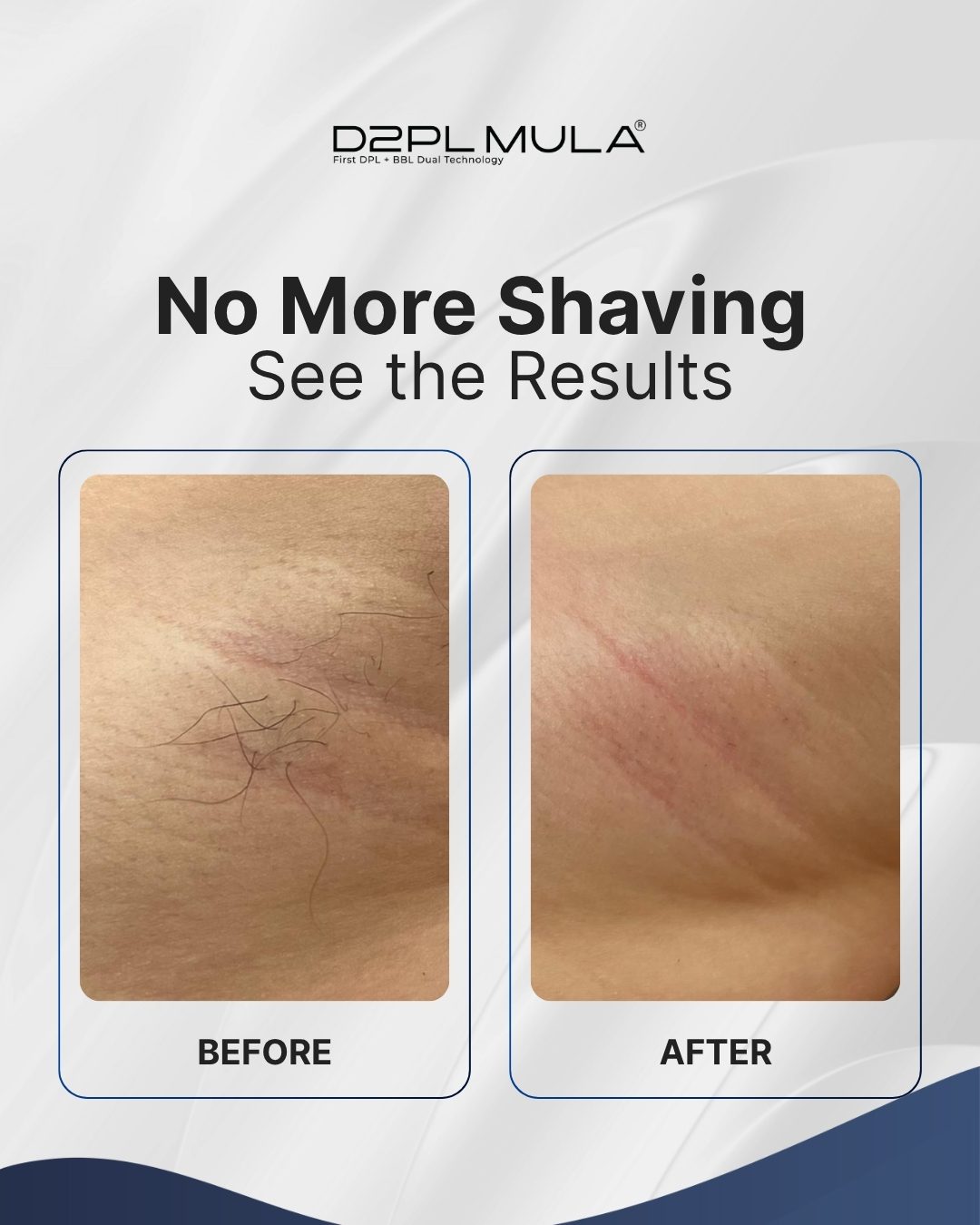BEFORE AFTER HAIR REMOVAL D2PL MULA (2)