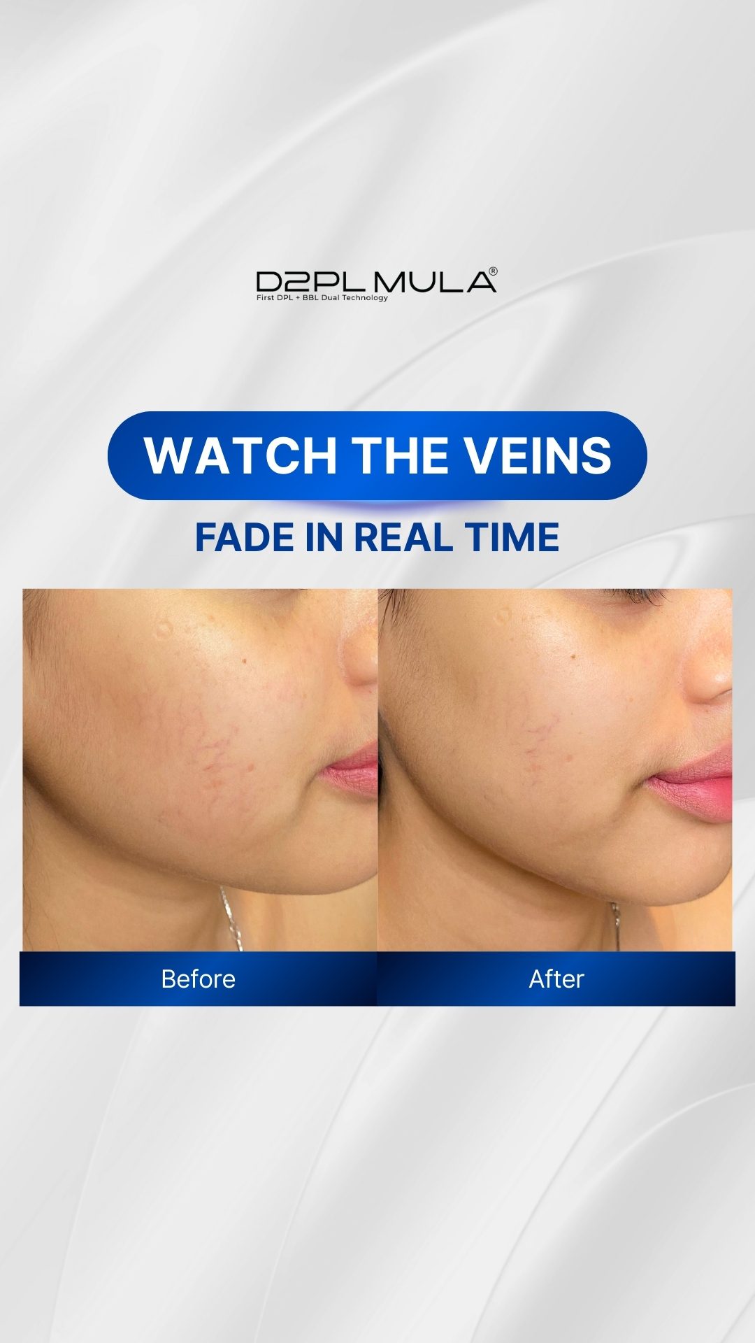 BEFORE AFTER VASCULAR