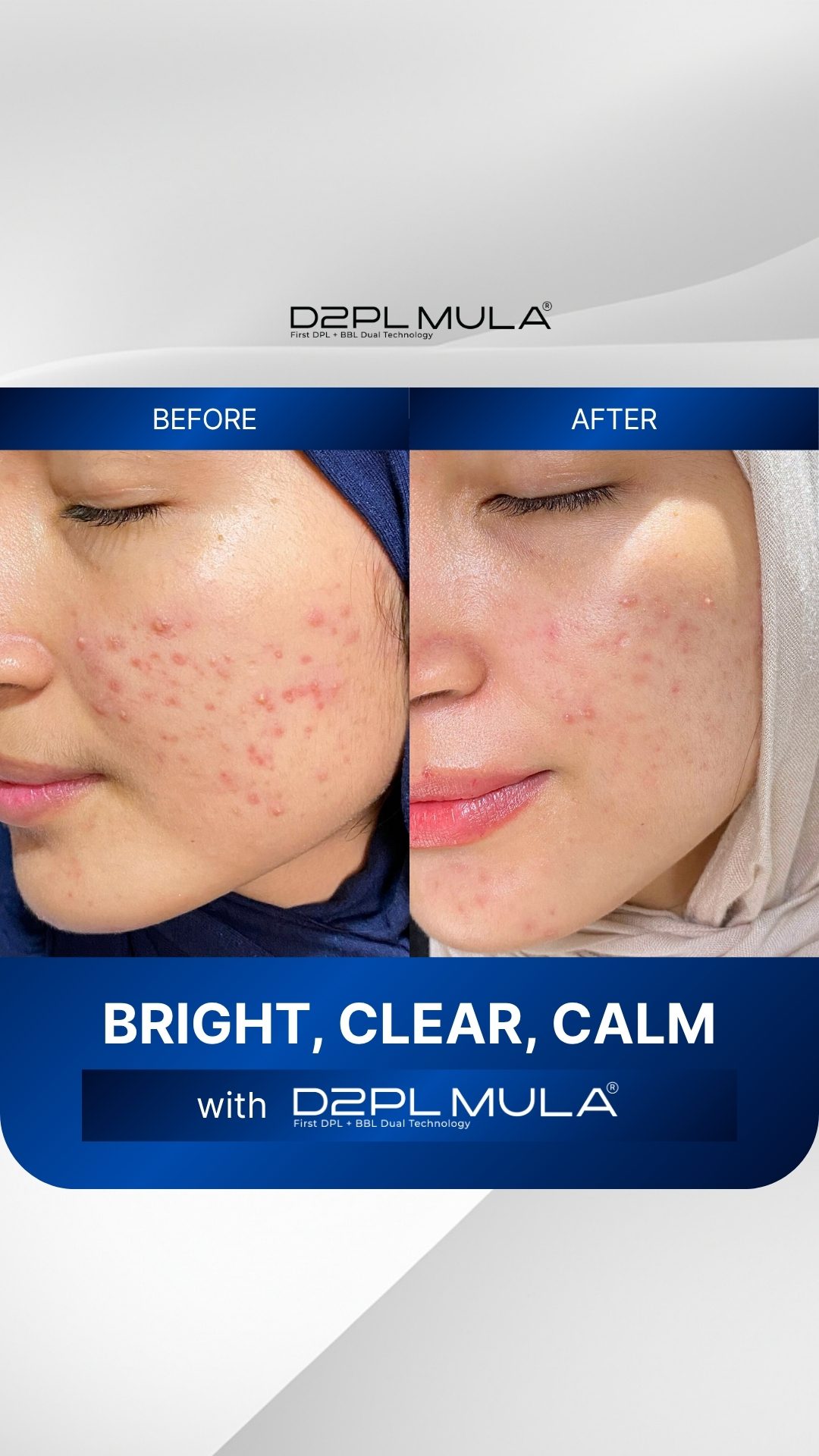 COVER MOTION BEFORE AFTER ACNE