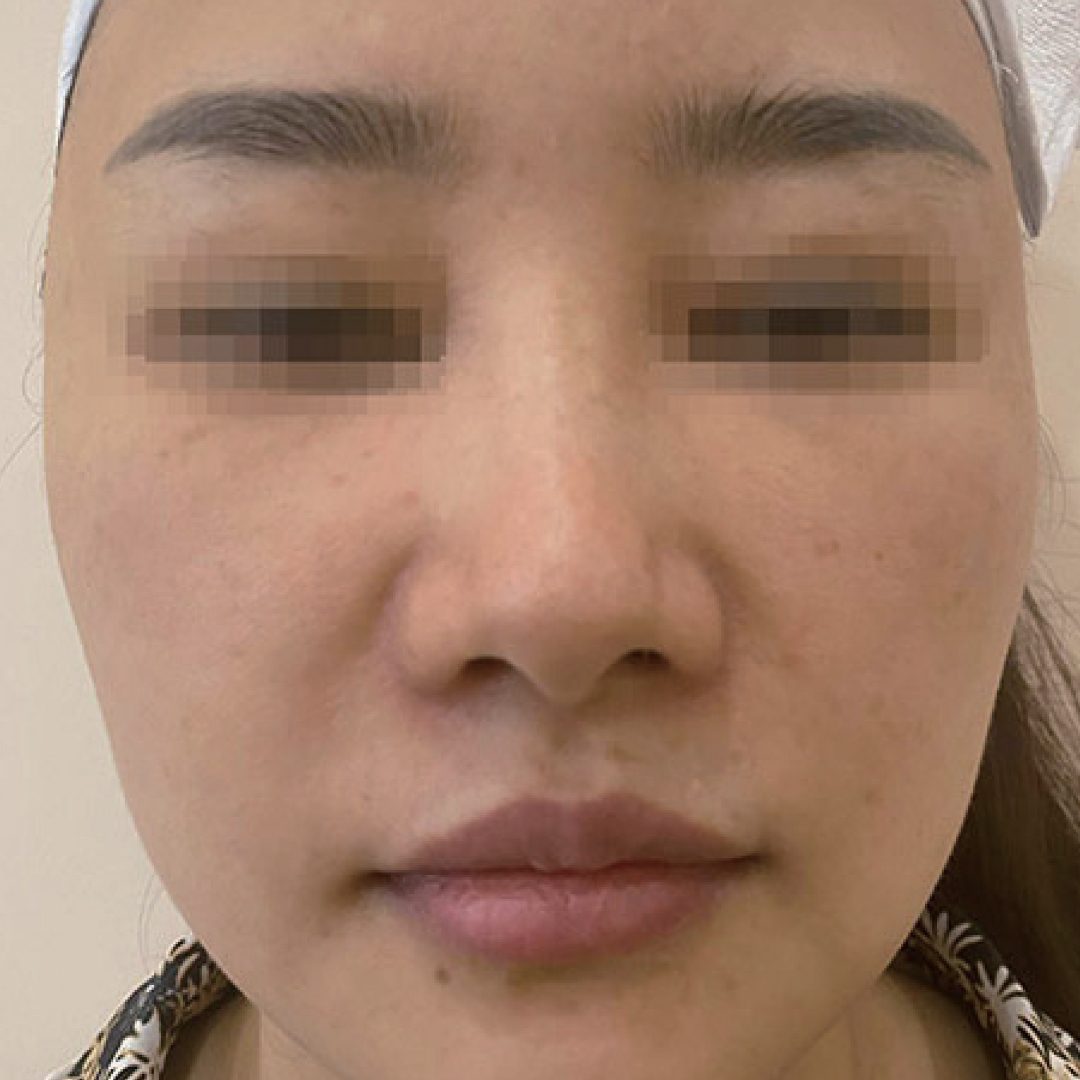 Before Pore Treatment