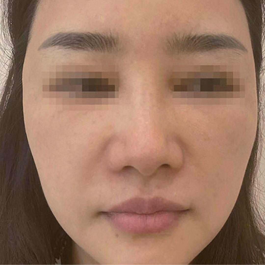 After Pore Treatment