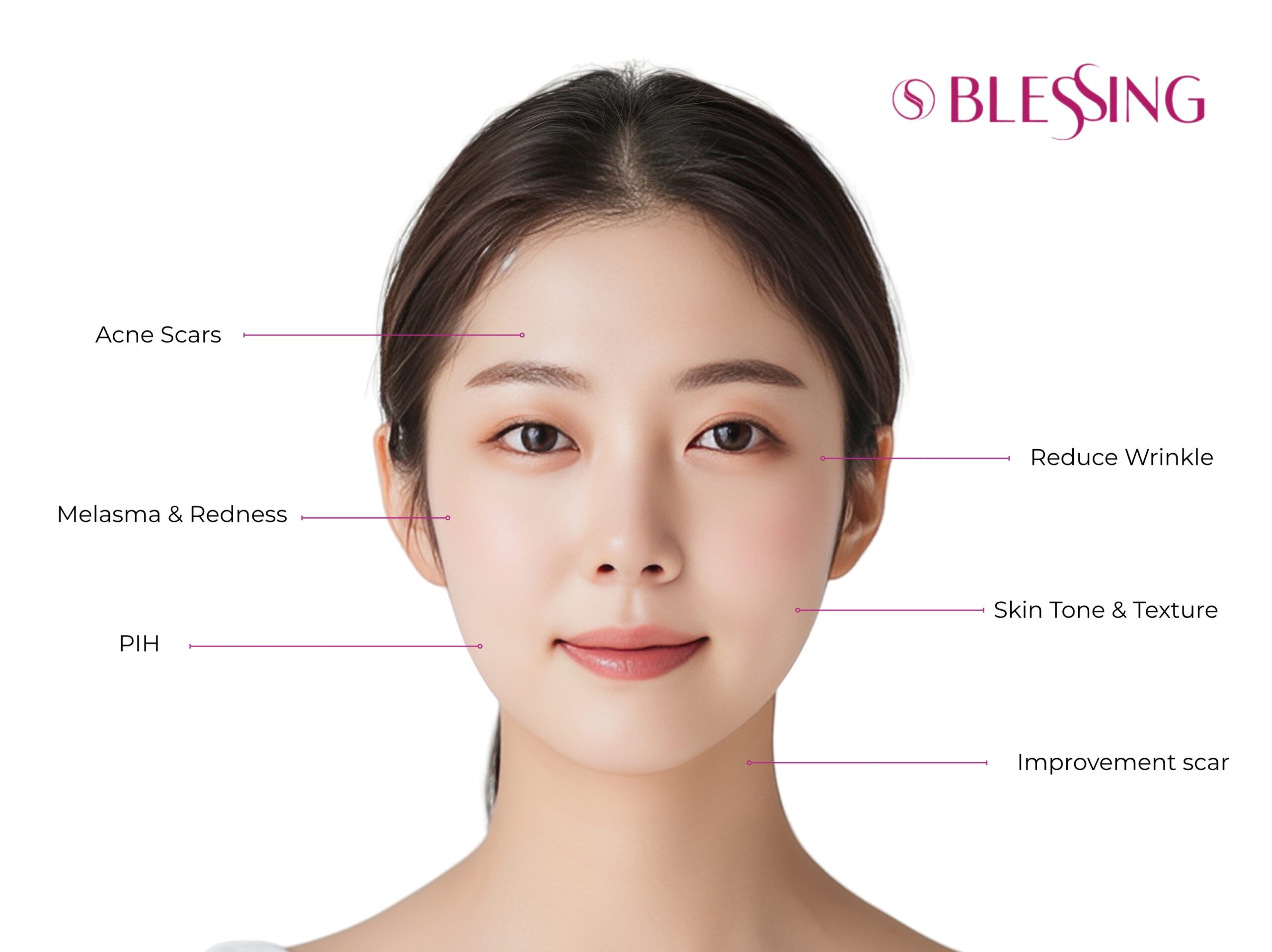 Blessing RF Treatment Results