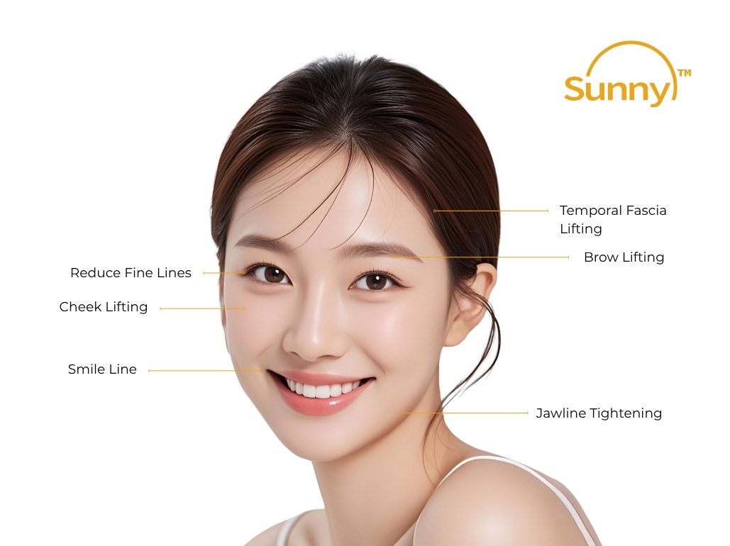 Sunny RF Treatment Results