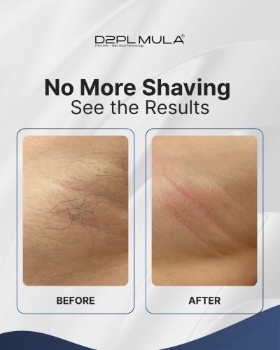 BEFORE AFTER HAIR REMOVAL D2PL MULA (2)