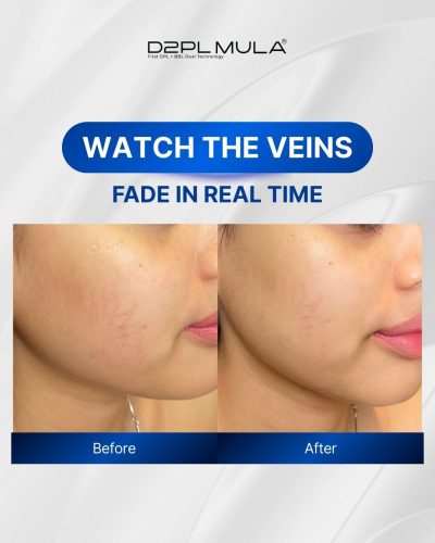 BEFORE AFTER VASCULAR
