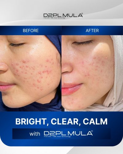 COVER MOTION BEFORE AFTER ACNE